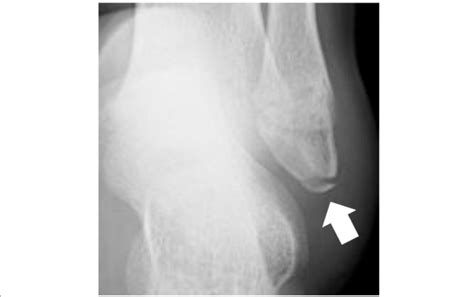 Anterior talofibular ligament view of the ankle. An avulsion fracture... | Download Scientific ...