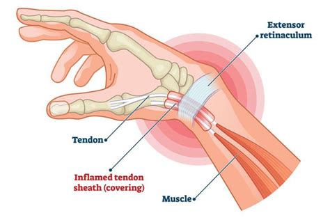 De Quervain's Tenosynovitis (Painful Wrist) - Causes and Symptoms | Parkway East Hospital