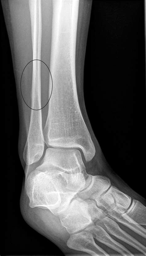 Stress Fracture X Ray Tibia