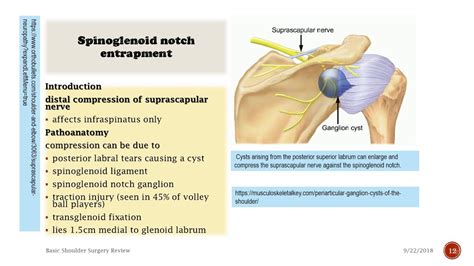 Suprascapular Neuropathy | Nerve entrapment, Neuropathy, Medical