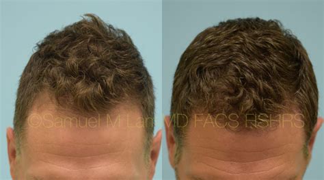 Dallas Finasteride and Minoxidil Before and After Photos - Plano Plastic Surgery Photo Gallery ...