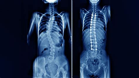 Spine Surgery: Meaning, Types and Risk Factors