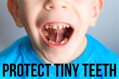 Tooth Decay in Children: Causes and preventive tips | by Kike Adeleye RN, BSN | Medium