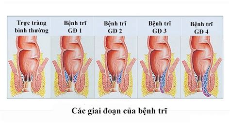 Nơi chữa bệnh trĩ chất lượng tại Đà Nẵng? ~ 1