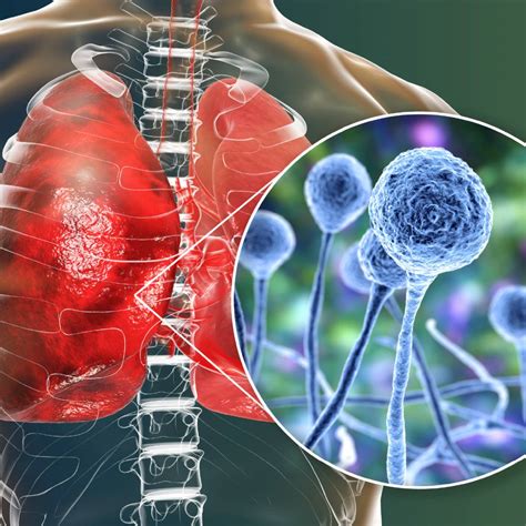 Medical Mycology