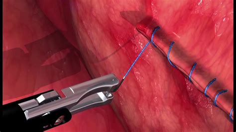 Laparoscopic Gastropexy For Large Breed Dogs | Veterinary Surgical Sutures With V-Loc Endostitch ...