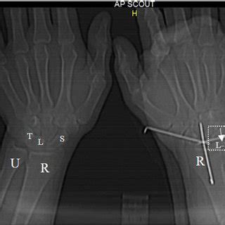 (PDF) Abnormal type III fusion between lunate and triquetrum: A case report