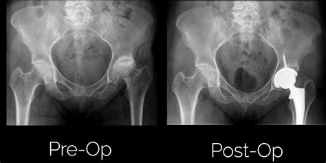 Anterior Total Hip Replacement | Sumit Rana, MD