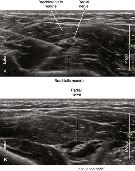 Radial Nerve Block | Radiology Key