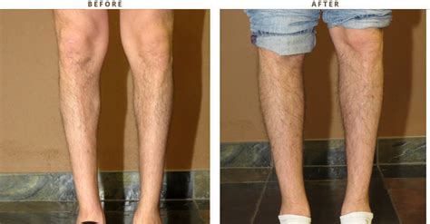 Calf Augmentation – Before and After Pictures * | Dr Turowski - Plastic Surgery Chicago