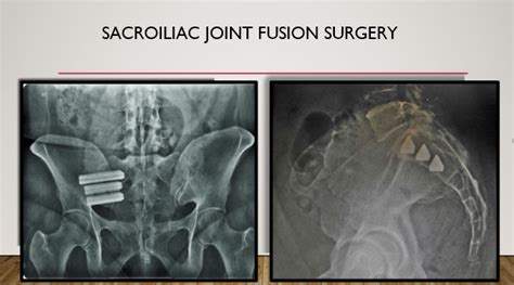 Sacroiliac Joint (SI) Fusion - Dr. Todd Jackman - Stillwater Spine Surgeon