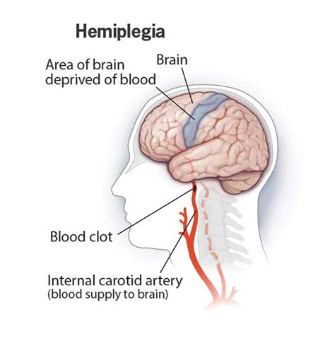 homeopathic treatment for Hemiplegia in homeopathy, Hemiplegia Treatment in Delhi, Kolkata ...