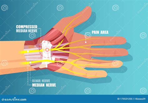 Carpal Tunnel Syndrome Concept Icon Cartoon Vector | CartoonDealer.com ...