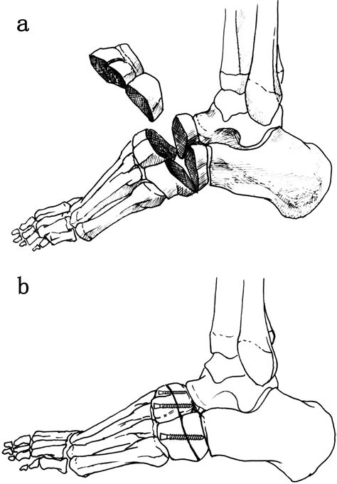 A prospective study of midfoot osteotomy combined with adjacent joint sparing internal fixation ...