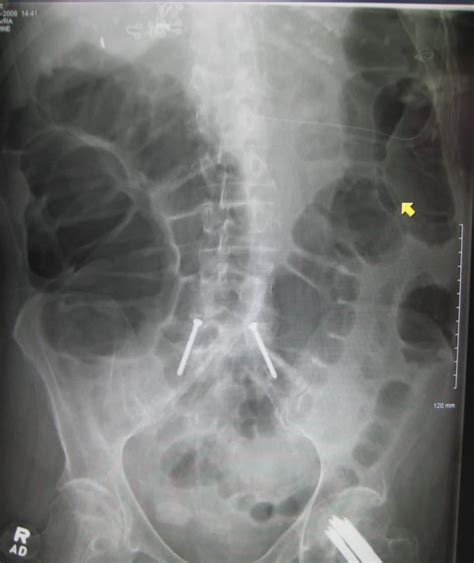 Abdominal X-ray Interpretation (AXR) | Radiology | OSCE | Geeky Medics