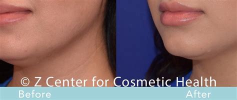 Coolsculpting Double Chin Before & After #7 - Zcosmetic Health