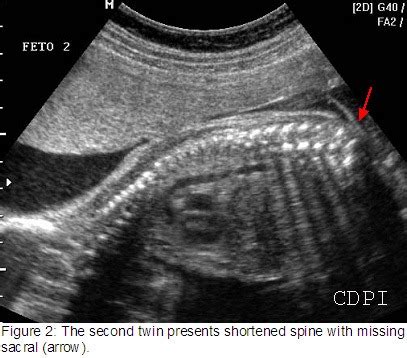 📃 MRI, Sacral agenesis