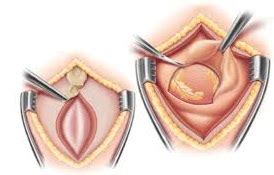 Pericardial Window | MedGuidance