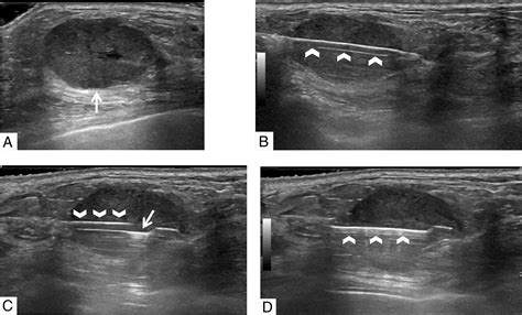 Ultrasound‐Guided Breast Biopsies - Bhatt - 2021 - Journal of ...