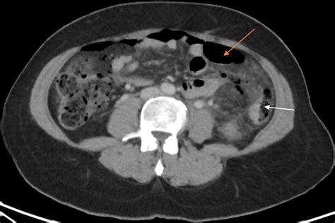 Cureus | Perforated Colon Cancer Associated With Post-operative Recurrent Bowel Perforations