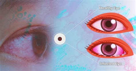 Conjunctivitis: Causes, Symptoms, Treatment and Prevention