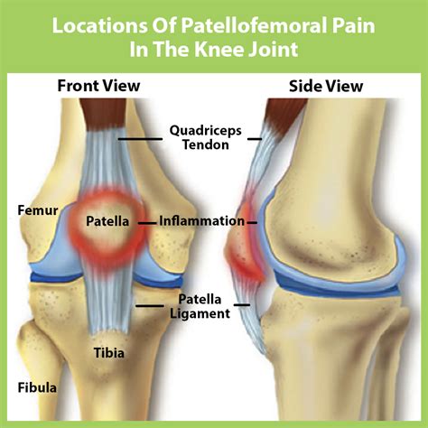 Runner's Knee - Carolinas Pain Center - Huntersville, NC - Charlotte, NC