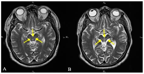 Diagnostics | Free Full-Text | Imaging Criteria for the Diagnosis of Progressive Supranuclear ...