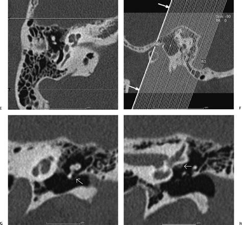 Temporal Bone Imaging Technique | Radiology Key