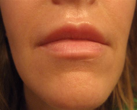 Chemical Peels for Acne and Anti Aging: Above Lip Vertical Lines - the ...