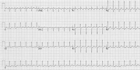 Supraventricular Tachycardia (SVT) • LITFL • ECG Library Diagnosis