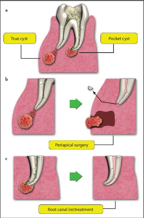 Figure 1 from Endodontic Periapical Lesion: An Overview on the Etiology, Diagnosis and Current ...