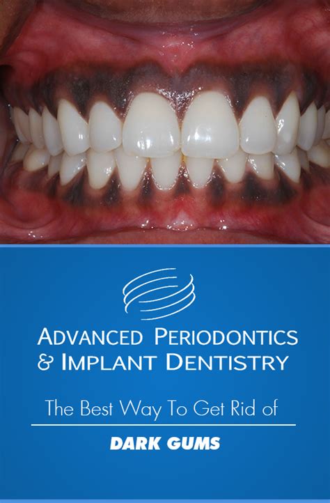 What is the best way to get rid of dark gums? - Laser Periodontics ...