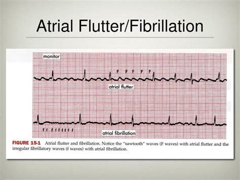 Atrial flutter vs atrial fibrillation - victoriasalo