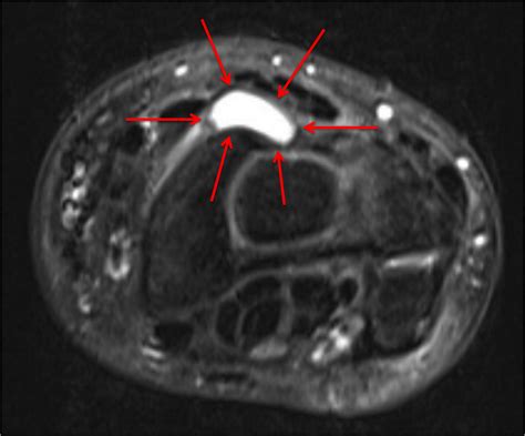 Lunate Ganglion Cyst