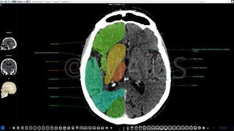 Brain, CT, Anatomy, Cerebral lobes, Ventricles | Brain anatomy, Anatomy, Human anatomy chart