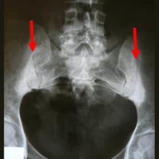 Sacroiliitis visible on a pelvic X-ray | Download Scientific Diagram