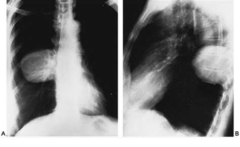 ON - RADIOLOGY: Neurogenic neoplasm in X-rays