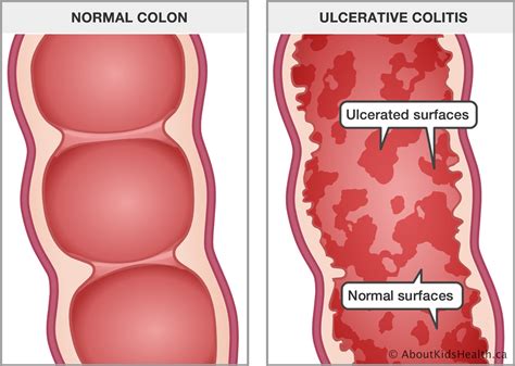 Ulcerative Colitis Symptoms, Causes, Treatment & Cure – Noster ProBiotics