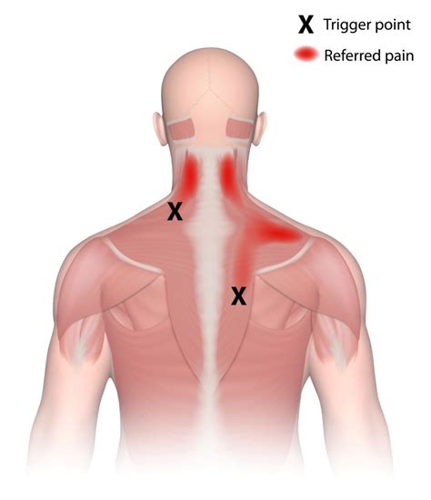 Les Trigger Points – PhysioMos