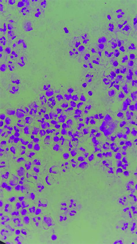 Purulent exudate from Bartholin's gland. Image represents one of the... | Download Scientific ...