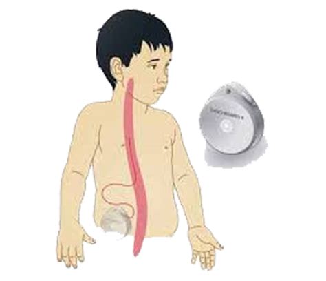 Intrathecal Baclofen Pump