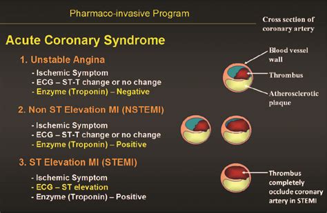 Pharmaco-invasive Therapy for STEMI; The Most Suitable STEMI ...