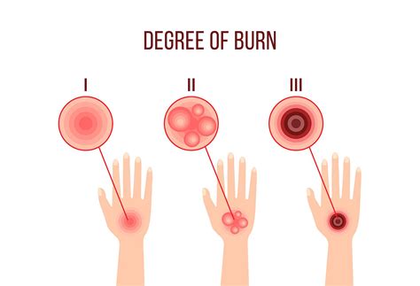 Burns: From First To Fourth Degree | The Well by Northwell