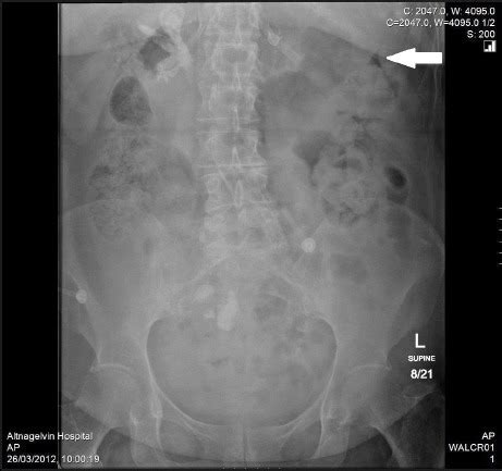 Supine anteroposterior abdominal radiograph showing fae | Open-i