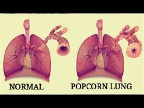 Does Vaping Cause Popcorn Lung? ( Vaping360 Article ) Vape Discussion Review - YouTube