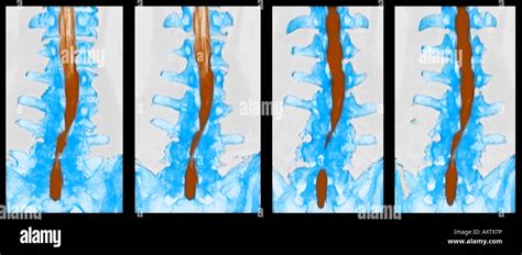 CT scan with myelogram showing spinal stenosis of the lumbar spine Stock Photo - Alamy