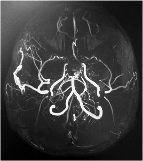 Magnetic resonance-angiography (MRA), brain MRA showing the occlusion... | Download Scientific ...