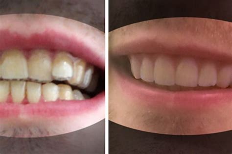 Here's How A College Student Created His Own Braces For Less Than $60