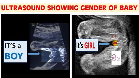 ULTRASOUND SHOWING BABY BOY VS BABY GIRL - YouTube