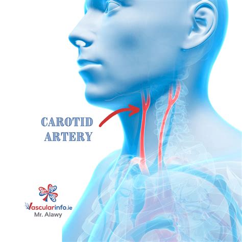 Carotid Body Tumor - Vascular Info